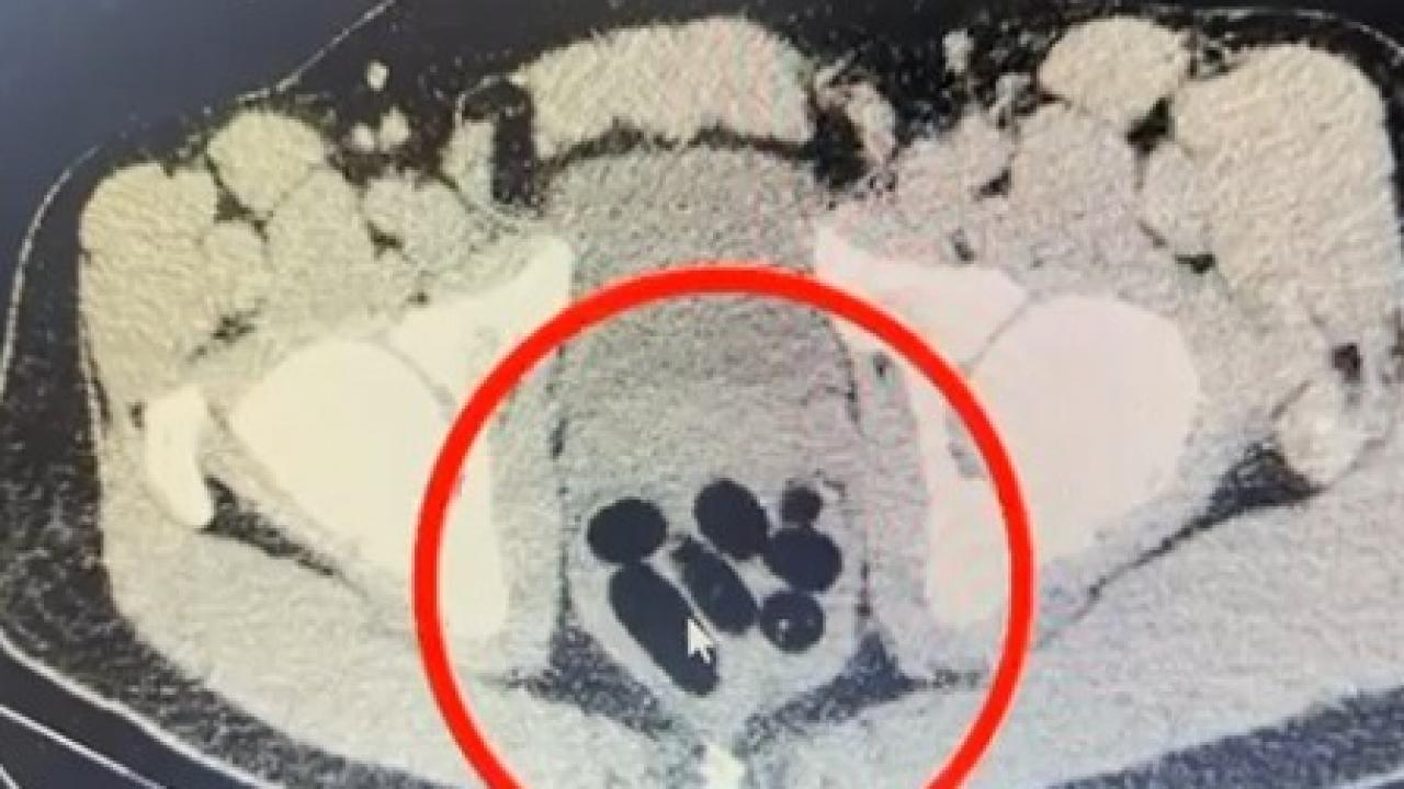 kayseride uyusturucu operasyonu midesinden cikan soke etti LMJQNlnS.jpg